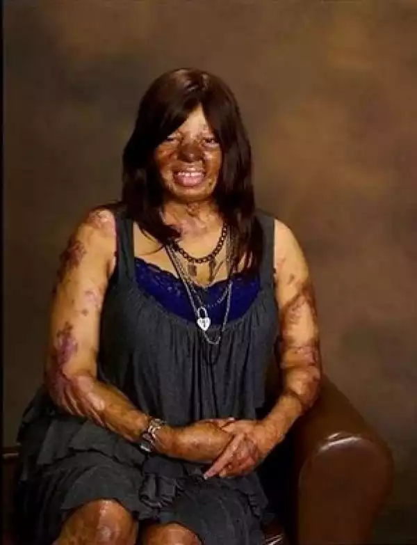 Throwback Pic Of Sosoliso Air Crash Survivor & Her Pics After Crash & 100 Surgeries